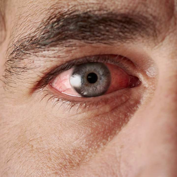 Konjunktivitis / Bindehautentzündung vor Behandlung durch Wiener Augenarzt