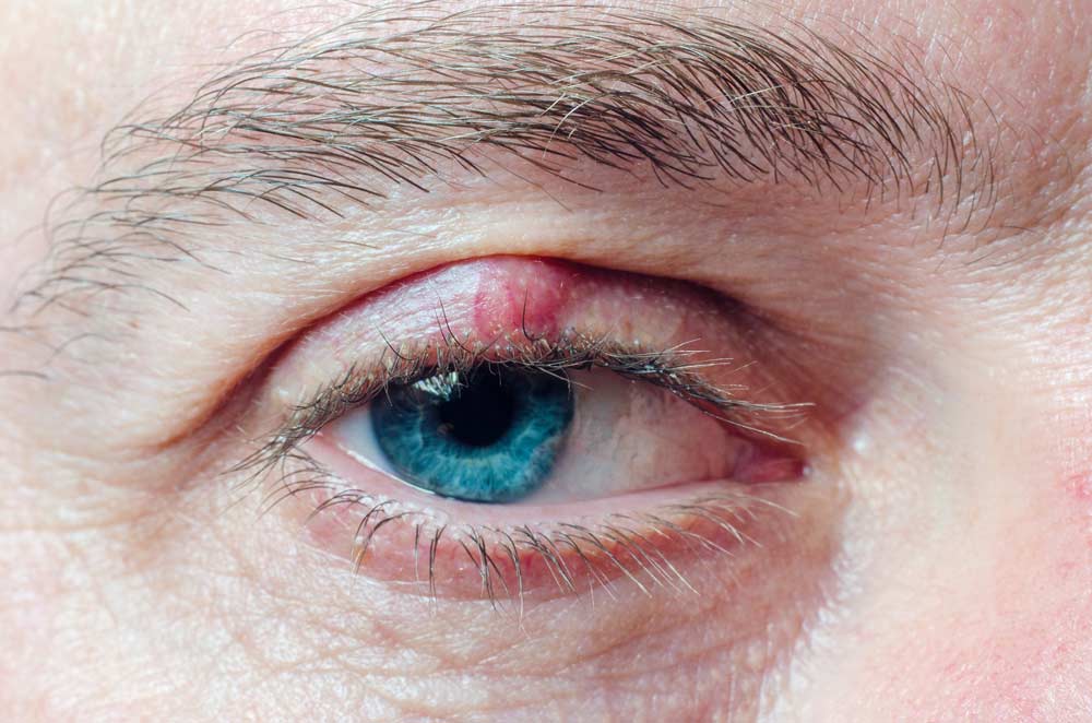 Hagelkorn Chalazion