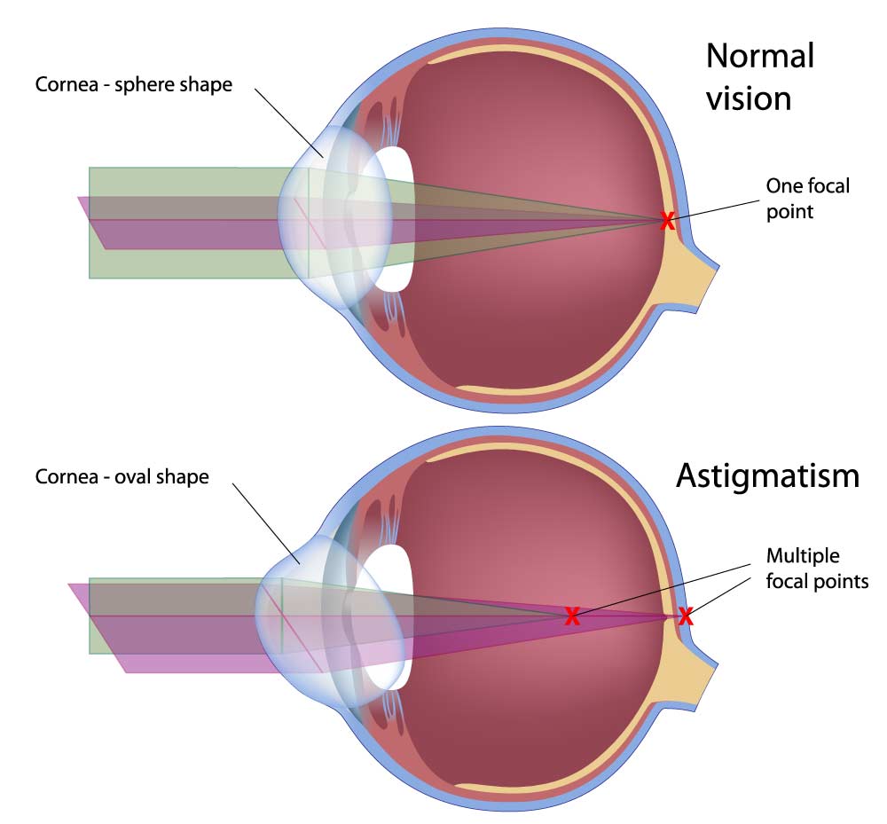 Hornhautverkrümmung / Astigmatismus Infografik