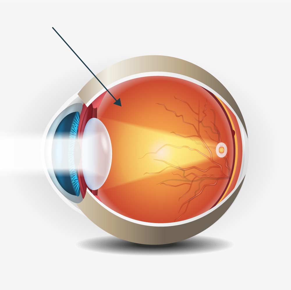 Injektion von Medikamenten ins Auge