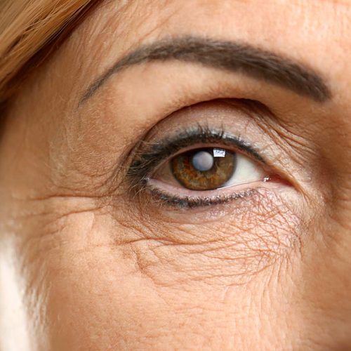 Grauer Star / Katarakt